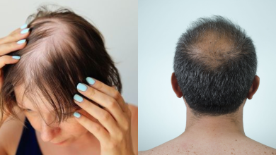 Genius ways to hide a bald patch