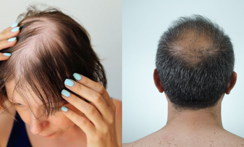 Genius ways to hide a bald patch