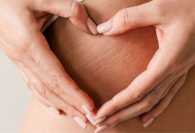 Best home remedies to get rid of stretch marks