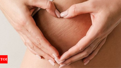 Best home remedies to get rid of stretch marks