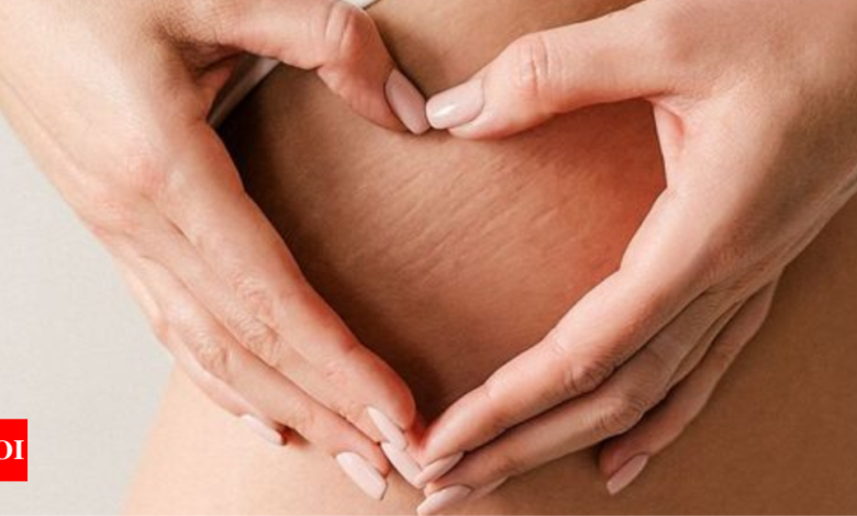 Best home remedies to get rid of stretch marks