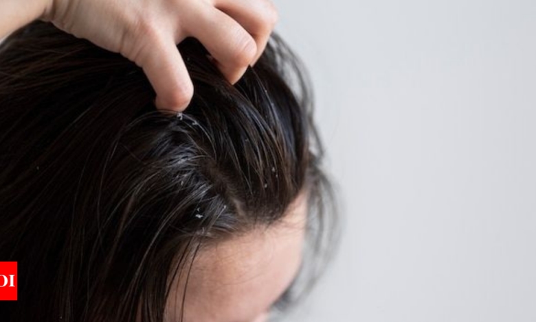 5 easy hacks to remove dandruff from your hair