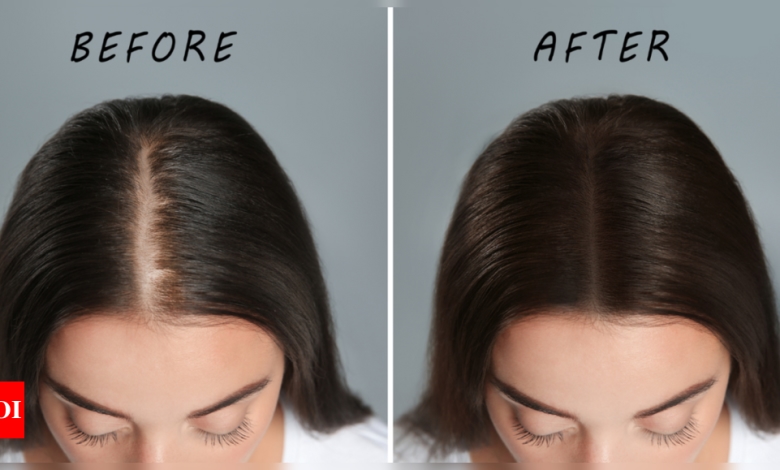 Coconut oil for hair growth: Explained: What is the correct way of massaging Coconut Oil to regrow hair in bald patches? |