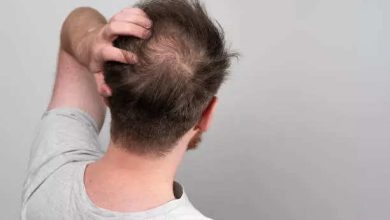 5 common causes of bald spots and how to tackle them