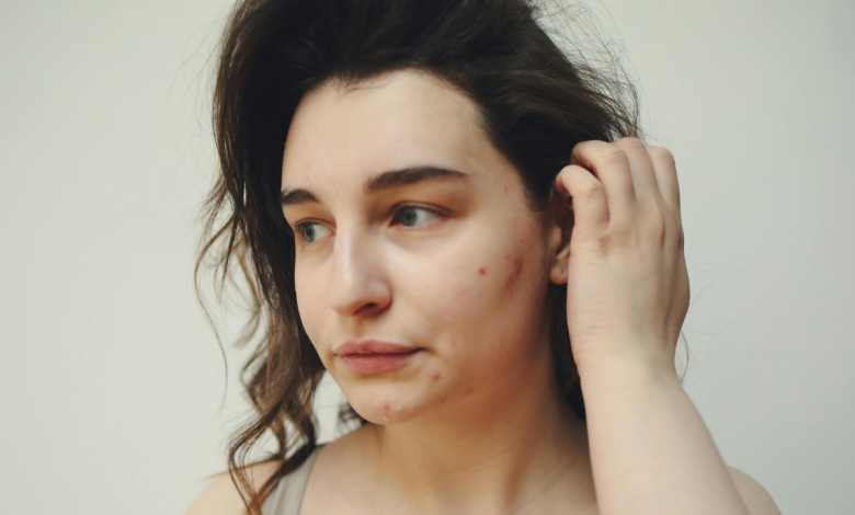 5 reasons why some adults have pimples and easy home remedies to get rid of them