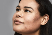 Summer acne struggles? Here’s how to keep breakouts at bay