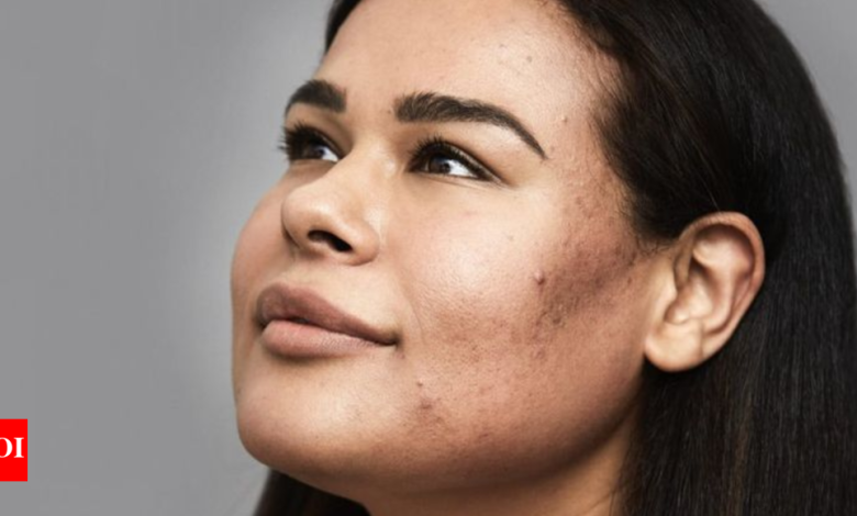 Summer acne struggles? Here’s how to keep breakouts at bay