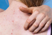 8 skincare hacks to deal with back acne