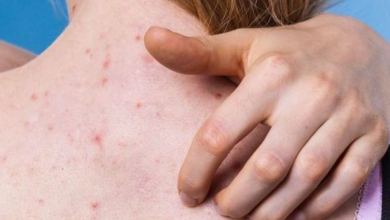 8 skincare hacks to deal with back acne