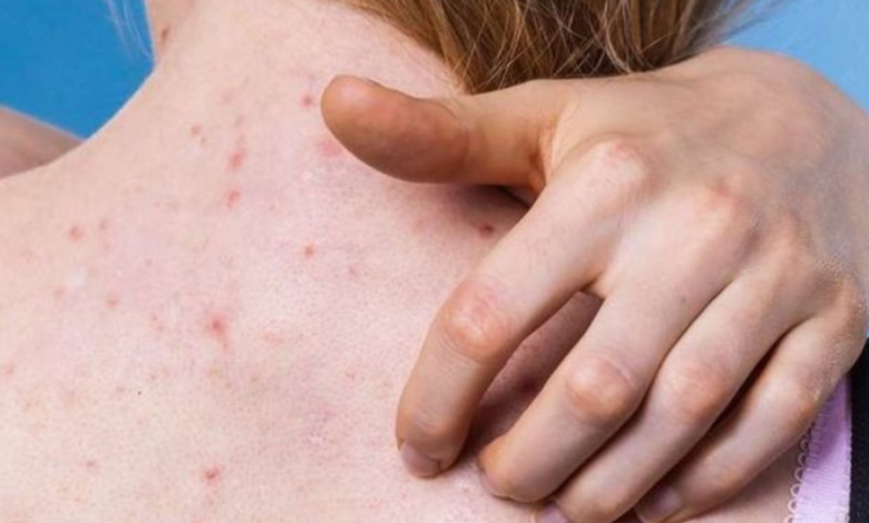 8 skincare hacks to deal with back acne