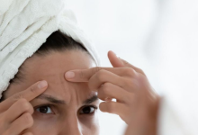 Try these 8 ways to get rid of a pimple in a day