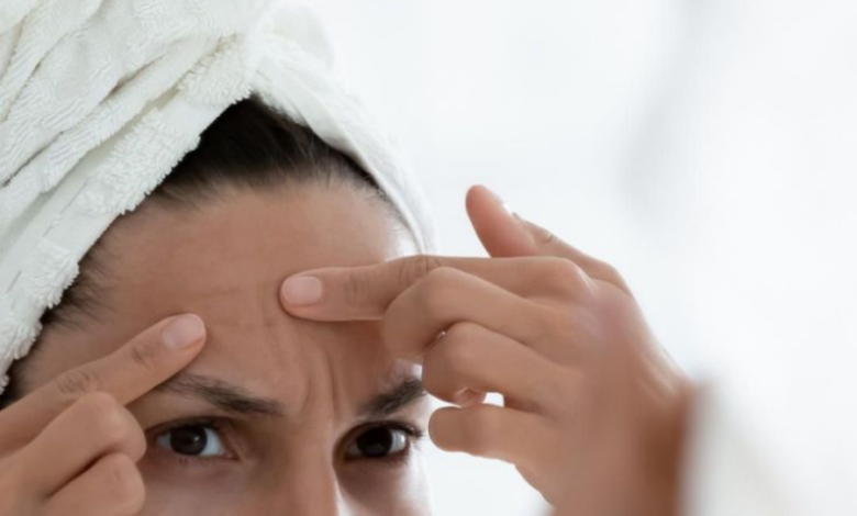Try these 8 ways to get rid of a pimple in a day
