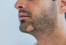 5 simple beard mask recipes to cover the unsightly bald patch
