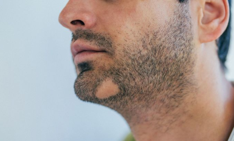 5 simple beard mask recipes to cover the unsightly bald patch