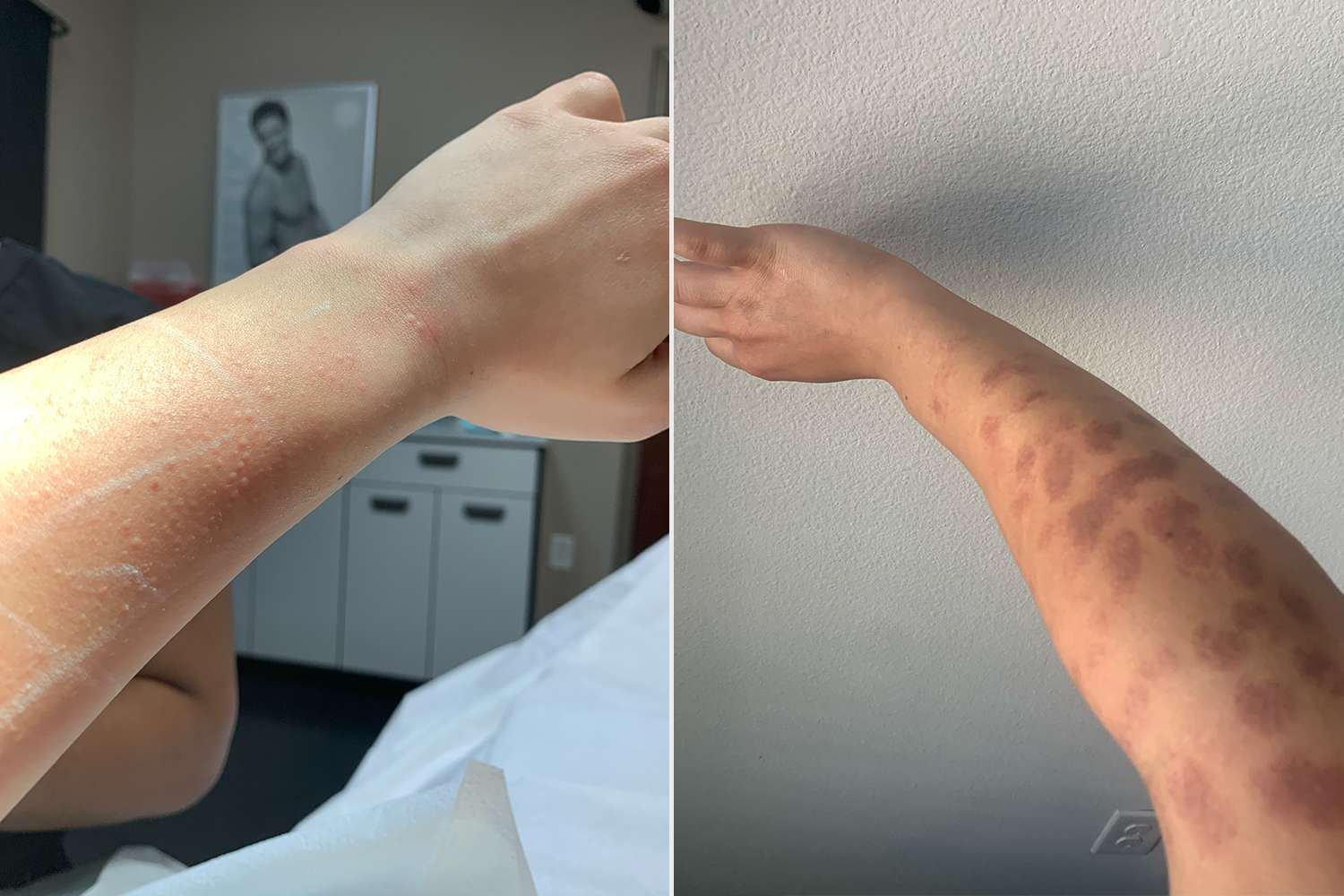 Bay Whittaker, Woman Turns to Electrolysis After Laser Hair Removal Left Her Covered in Burns 