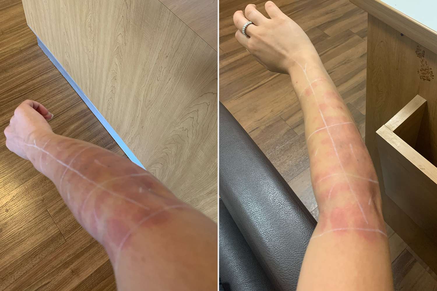 Bay Whittaker, Woman Turns to Electrolysis After Laser Hair Removal Left Her Covered in Burns