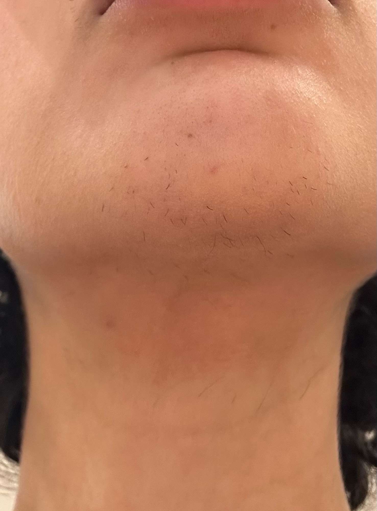 Paradoxical hair growth, Bay Electrolysis