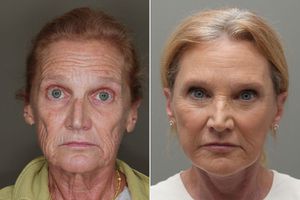 facelift before and after