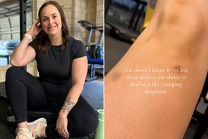 Woman's bruising leads to lipedema diagnosis.
