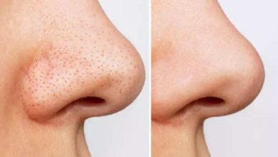 5 desi hacks to get rid of Blackheads