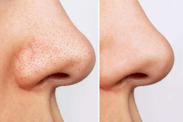 5 desi hacks to get rid of Blackheads