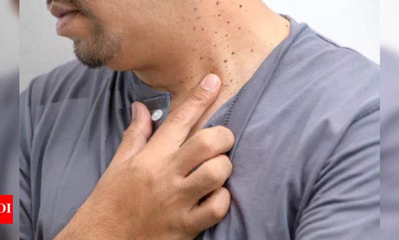 Skin tags vs warts vs moles: How to tell the difference |