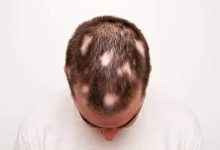 Alopecia Areata: Home remedies that can help in reversing Alopecia Areata or spot baldness |