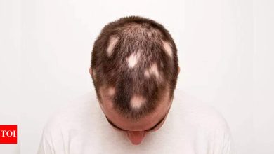 Alopecia Areata: Home remedies that can help in reversing Alopecia Areata or spot baldness |
