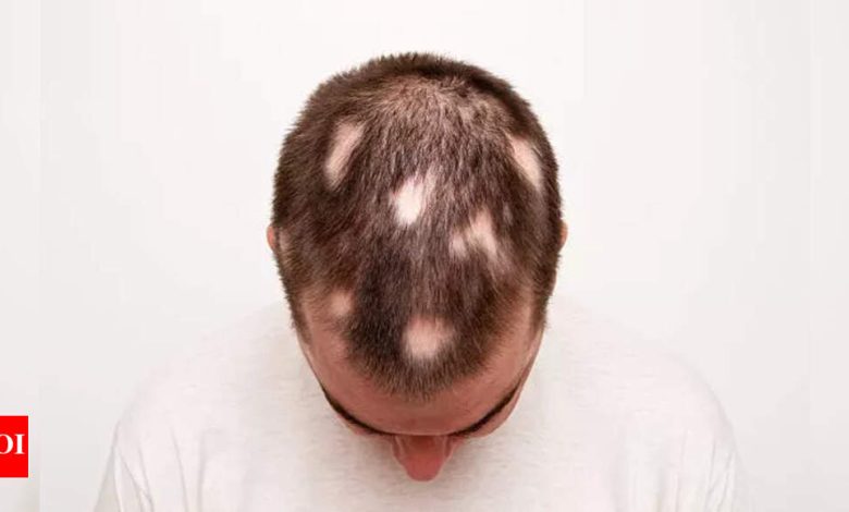 Alopecia Areata: Home remedies that can help in reversing Alopecia Areata or spot baldness |