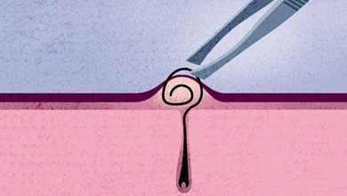 5 quick and easy fixes for ingrown hair