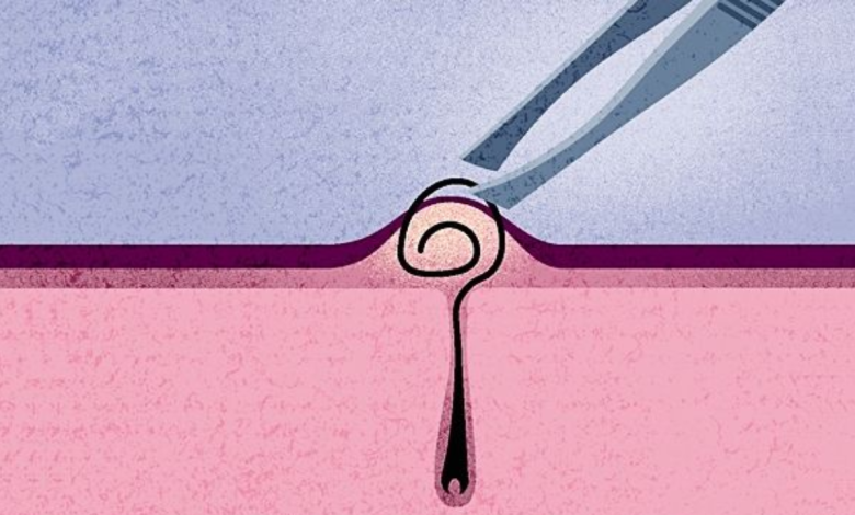 5 quick and easy fixes for ingrown hair