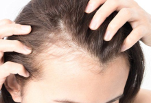 5 natural ways to curb scalp inflammation