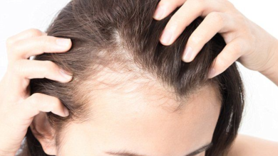 5 natural ways to curb scalp inflammation