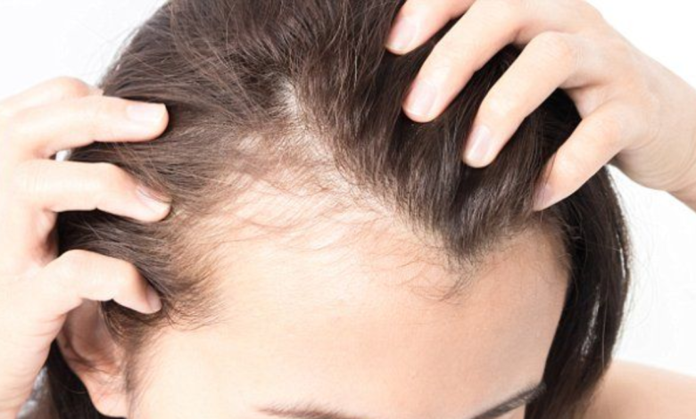 5 natural ways to curb scalp inflammation