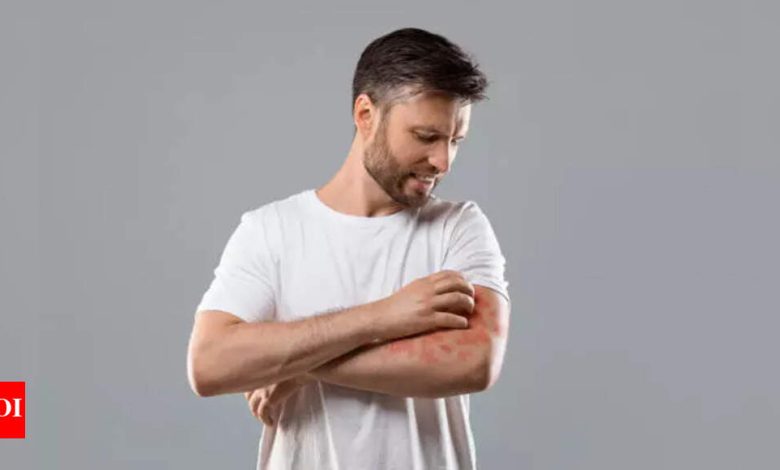 Why fungal acne gets worse during monsoon and what experts say you should do