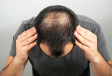 Beat early balding issues with these 4 home remedies