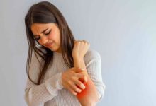 Want to get rid of hives? 9 effective ways to get relief