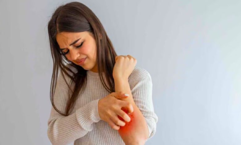 Want to get rid of hives? 9 effective ways to get relief