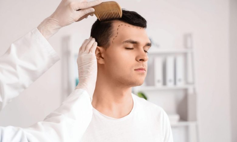 Hair Transplant: A Permanent Solution To Hair Loss